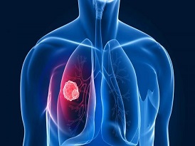 呼吸机相关性肺炎活检分析方案